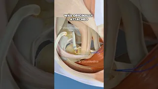 Tommy John Surgery UCL Reconstruction 3D Animation