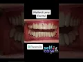 Download Lagu Broken teeth fix