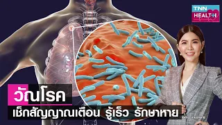 วัณโรคเกิดจากเชื้ออะไร และสามารถส่งผลต่ออวัยวะใดบ้าง
