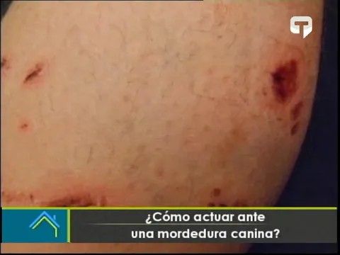 ¿Cómo actuar ante una mordedura canina?
