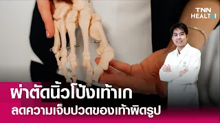 หากปล่อยนิ้วโป้งเท้าเกไว้โดยไม่รักษา จะเกิดผลเสียอย่างไรบ้าง