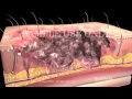 Burns Classification and Treatment