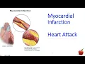 ICD 10 CM coding for a Heart Attack STEMI vs NSTEMI for Beginners