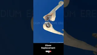 Total Elbow Replacement 3D Medical Animation