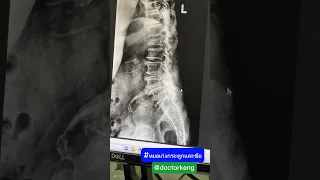  ทำไมคนอายุมากที่ล้มแล้วปวดหลังจึงมีกระดูกยุบ และเกิดอาการปวดมากขึ้นได้ 