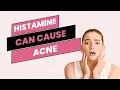 Histamine can cause acne