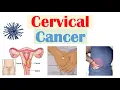 Cervical Cancer Risk Factors Pathophysiology Symptoms Staging Diagnosis Treatment Prevention