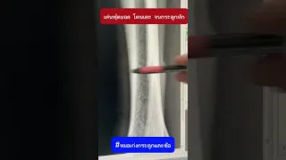  อาการบวมและเจ็บที่เข่าหลังการเล่นฟุตบอลรุนแรงเกิดจากสาเหตุอะไร 