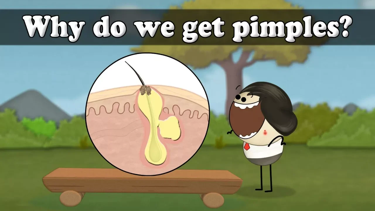 Why do we get pimples? | #aumsum #kids #science #education #children