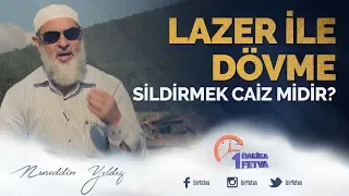 Lazer ile dövme sildirmek caiz midir?