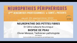 Neuropathie des petites fibres