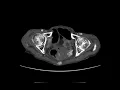 Obturator hernia A Ahuja AT et al 2017 Book Essential Radiology