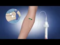 Initial Specimen Diversion Tube from C-Quest Medical