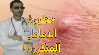 أسباب الدمامل المتكررة فى الجسم ودلالاتها على الصحة مضاعفاتها على الصحة العلاج 