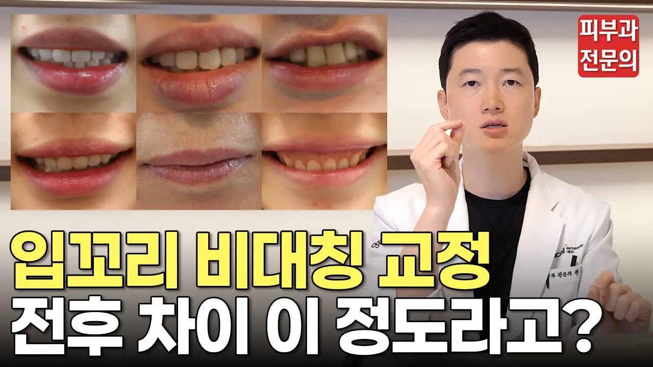 입꼬리 비대칭·입술 비대칭 교정하면 이렇게 됩니다ㅣ입술 비대칭 교정, 입술 비대칭 보톡스, 필러, 입꼬리 비대칭 교정, 입꼬리 보톡스 후기, 동대문 피부과, 청량리 피부과