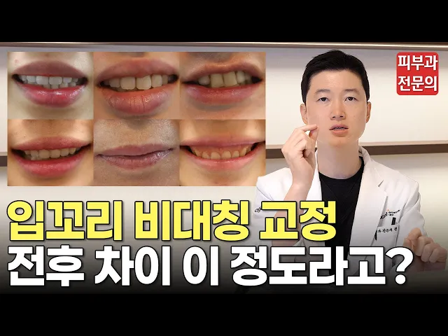 입꼬리 비대칭·입술 비대칭 교정하면 이렇게 됩니다ㅣ입술 비대칭 교정, 입술 비대칭 보톡스, 필러, 입꼬리 비대칭 교정, 입꼬리 보톡스 후기, 동대문 피부과, 청량리 피부과