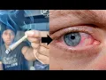 DO MY EYES STILL GET RED