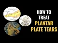 Plantar Plate Tears - How to treat them