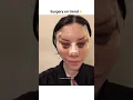 Download Lagu full face surgery😱🔥#shorts #cosmeticsurgery #beauty