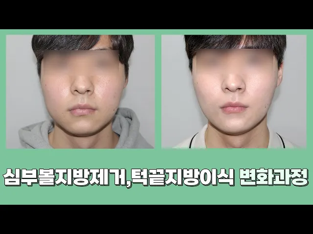 심부볼지방제거와 턱끝지방이식 같이한다면 어떻게 될까?