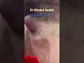 Download Lagu Large abscess Dr Khaled Sadek #blackheads #skincare LIPOMACYST clinic
