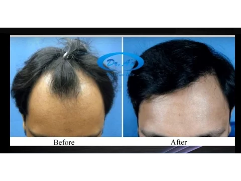 Download MP3 Best Hair Transplant in New Delhi, India | Dr. A's Clinic | Dr. Arvind Poswal