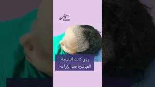 من جبهة عريضة كانت مضايقاني لشكل طبيعي 100 