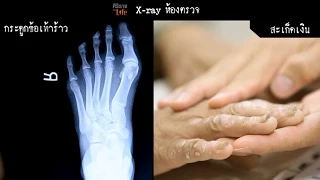 ทำไมการใส่รองเท้าที่ไม่เหมาะสมถึงทำให้เกิดอาการบาดเจ็บที่เท้า