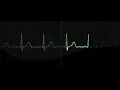 Download Lagu 9 hours of Heart rate monitoring EKG grapihics with beeping