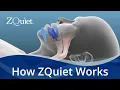 Download Lagu Want to Stop Snoring? Learn How ZQuiet Anti Snoring Mouthpieces Work