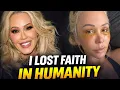 Bunnie Xo Shares Painful Facelift Recovery Update Lost Faith in Humanity Shocks Fans
