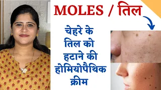 Download Mole Removal Cream ॥ चेहरे के तिल को हटाने की होमियोपैथिक क्रीम॥ MP3