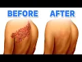 How to NEVER Get Shingles Again