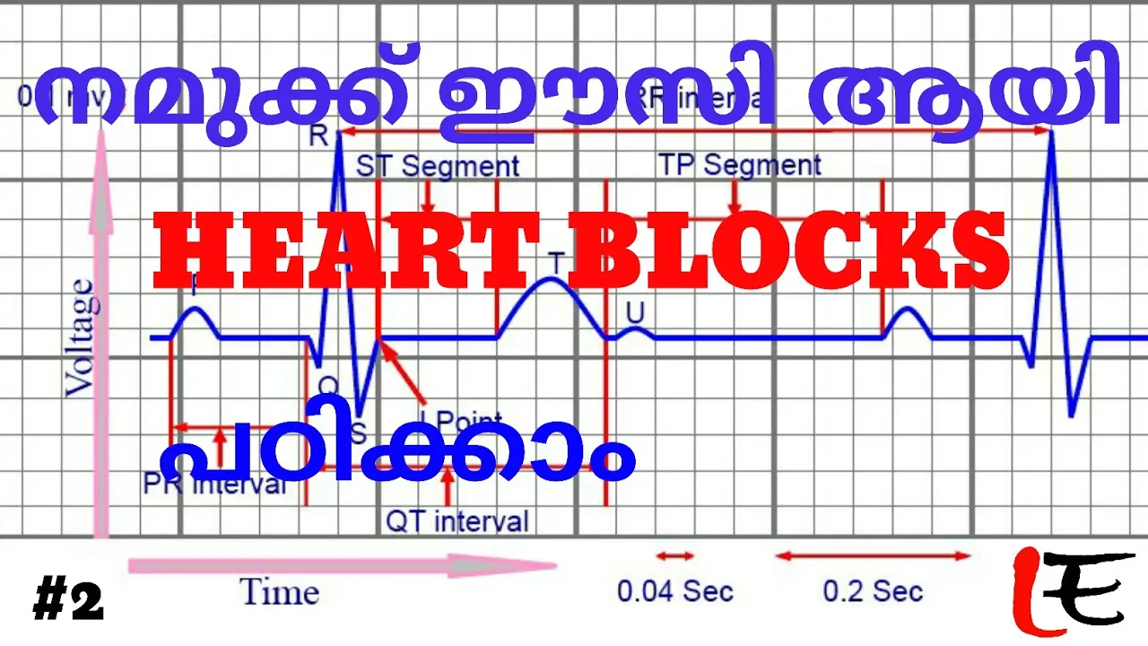 Basics of ECG (episode#2), AV blocks, heart blocks, 1,2,3 degree blocks in Malayalam
