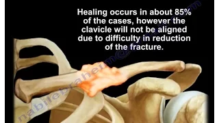 malunion of the clavicle everything you need to know dr nabil ebraheim