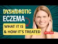 What is Dyshidrotic Eczema And How It s Treated