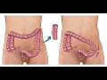 Sigmoid colectomy CPT code - simplify medical coding