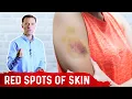 What Causes Bruises on Legs Arms - Top 5 Causes of Bruising Covered by Dr Berg