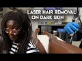 My Laser Hair Removal Experience as a Dark Skin Woman LaserAway