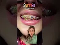 Best Braces Colors-Summer Colors Combo