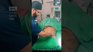 شد البطن بعد العملية مباشرة 