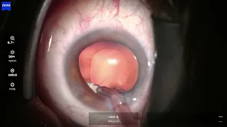 02 Phaco Odyssey 0j43e 260820