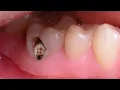 Download Lagu Trám răng sâu xoang 5 (fillings caries)