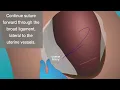 O LEARY Procedure