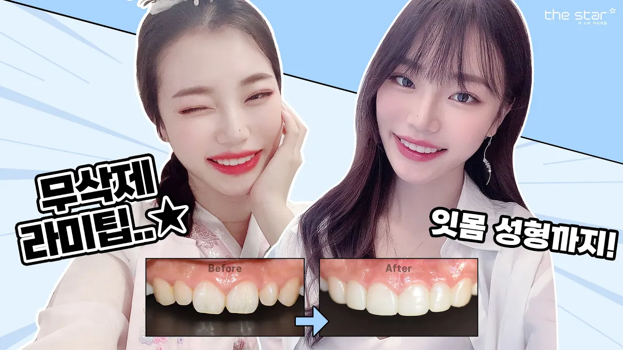 [더스타치과]잇몸교정과 무삭제 라미팁의 콜라보🥰