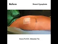 Download Lagu Breast Augmentation Turkey
