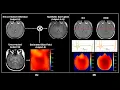 S121 Bias Field Correction in MRI With Hampel Noise Denoising Diffusion Probabilistic Model