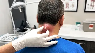 he shouldn't have squeezed it...