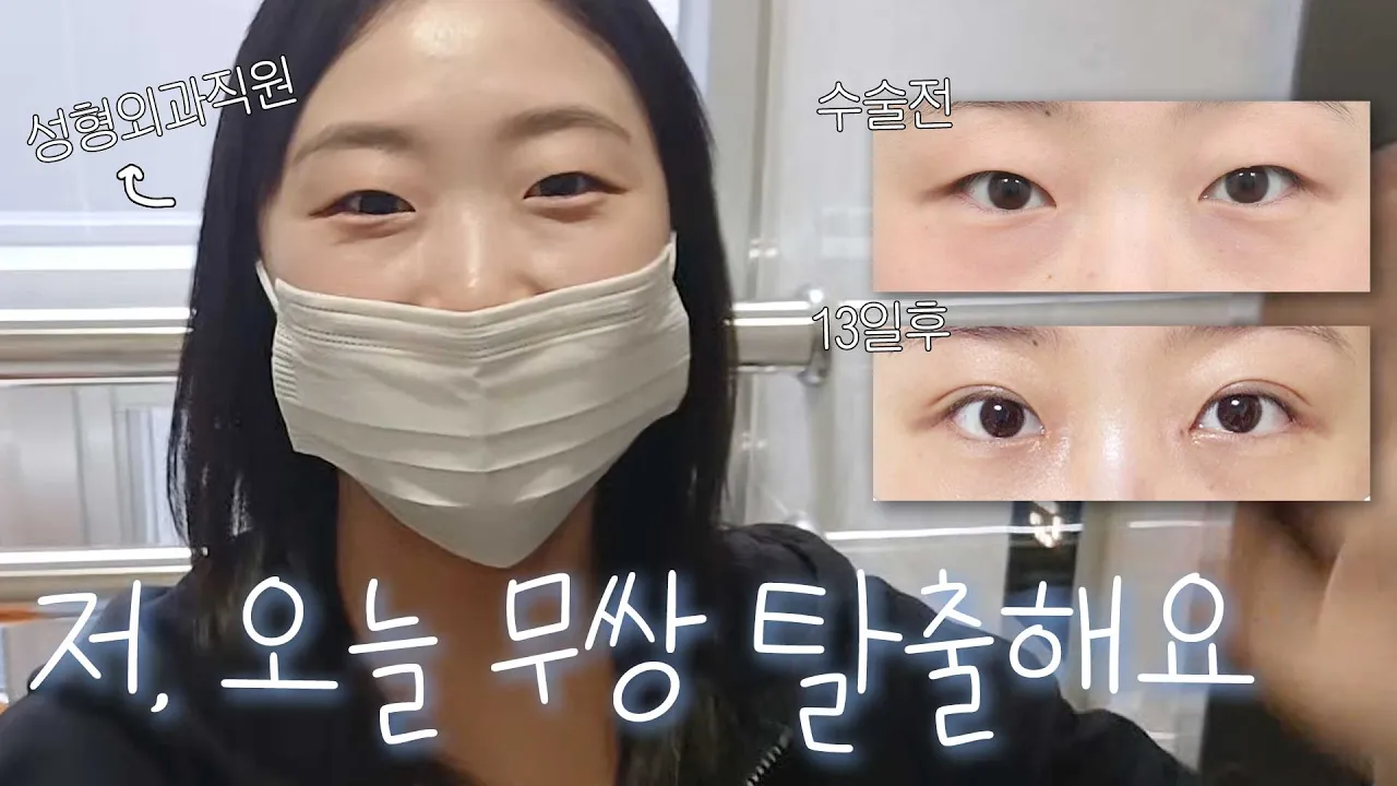 성형외과 홍보팀 직원의 내돈내산 쌍수 브이로그✨ 점심시간에 상담받고 수술대 위까지 올라간 리얼 스토리 | 비포애프터 사진⭕| 에이비성형외과