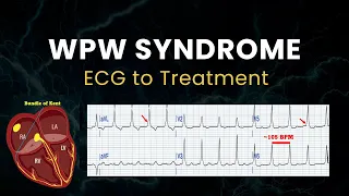 Wolff Parkinson White WPW Syndrome ECGs To Treatments 